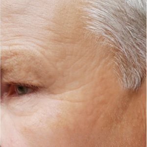 Before and after comparison of an elderly person's face with visible wrinkles.
