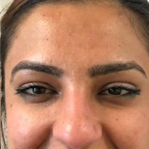 Before and after comparison of a woman's face with visible skin improvement.