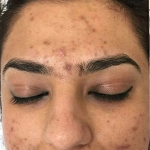 Before and after comparison of a woman's face with visible skin improvement.